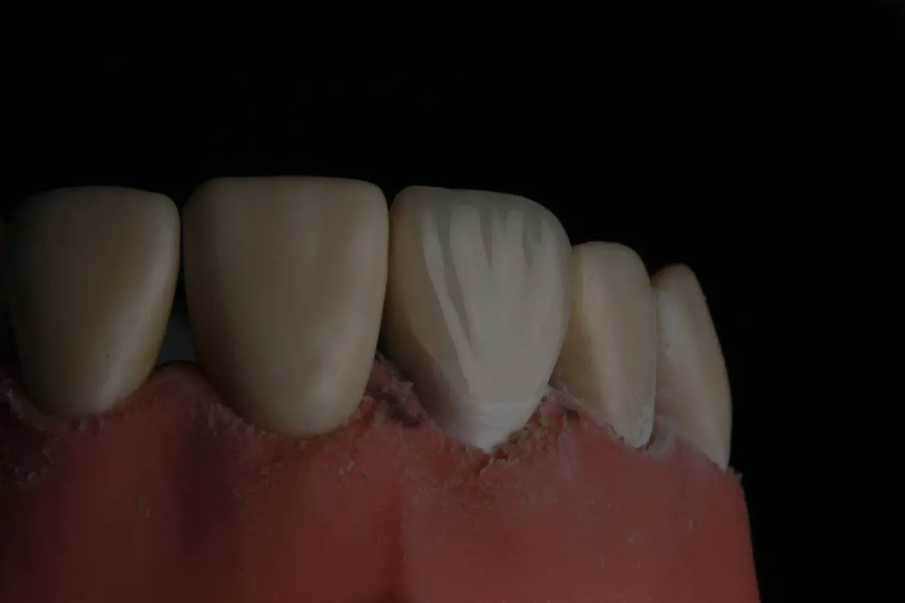 Coronas de prótesis digital alineadas sobre la mesa de trabajo